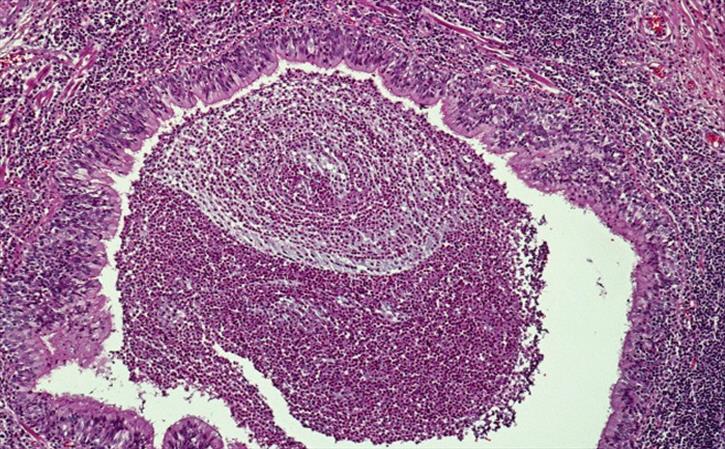 Bronchiectasis